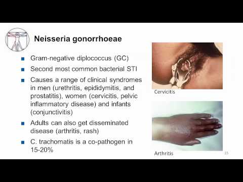 Video: Cervicitis - Chlamydial Cervicitis, Symptomer Og Behandling