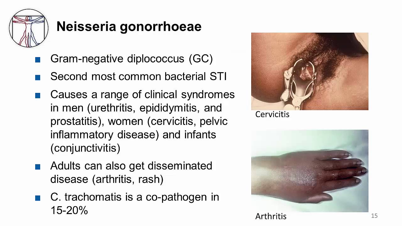 disseminated gonorrhea symptoms