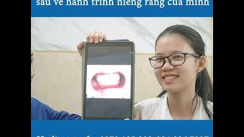 KẾT QUẢ SAU KHI NIỀNG RĂNG - BỆNH VIỆN THÁI THƯỢNG HOÀNG