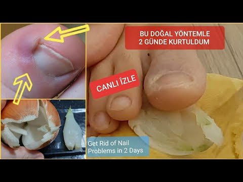 WATCH HOW WE GET RID OF NAIL SINKING JUST IN 2 DAYS-WITH THIS TREATMENT,U  WILL BE VERY SURPRISED😯