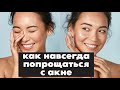 Как избавиться от Акне навсегда? / Советы доктора