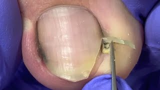 Paronychia pus from trimming, severe ingrown toenails【Doctor Liu Pedicure】