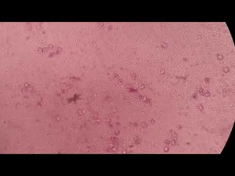 Mikroskopik Urine Shih Yung: Bakteri & Leukosit