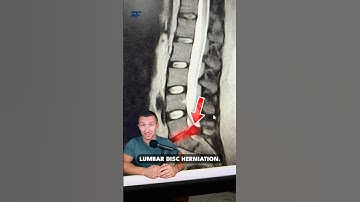 MASSIVE Disc Herniation in Low Back!