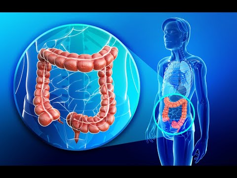 Video: Este o colostomie reversibilă?