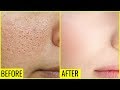 How to Get Rid of Large OPEN PORES Permanently | Anaysa