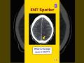 ENT Radiology - Read the film #neetpg #pgentranceexam #theentresident