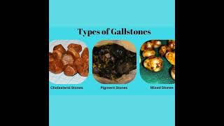 SAY GOODBYE FOR GALLBLADDER STONES WITH HOMEOPATHY TREATMENT