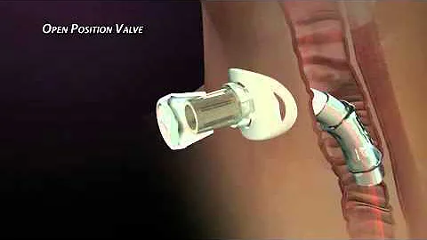 Passy-Muir Valve Design