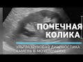 КАМЕНЬ В МОЧЕТОЧНИКЕ 😰 Ультразвуковая диагностика 🏥 UROLITHIASIS on ultrasound