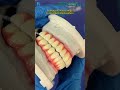placement of a full-arch Malo bridge with zirconia crowns.#dental #china #dentures #aesthetic