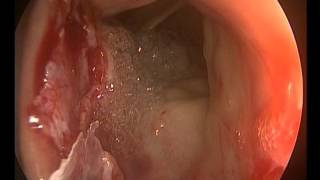 Polyp Surgery with Microdebrider by Dr.T K Ghosh