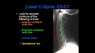 Radiology of Spine Trauma