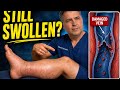 Post-Thrombotic Syndrome — What Happens After a Blood Clot (And Why It’s Not What You Think)