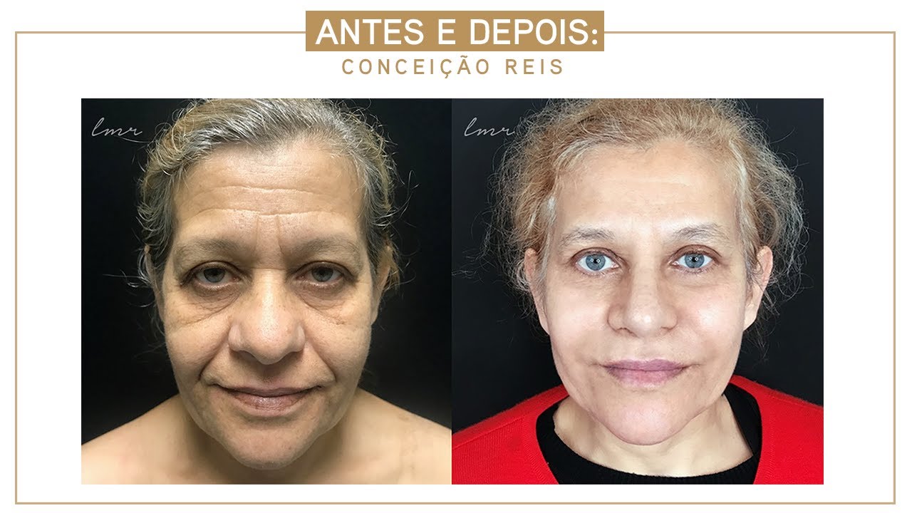 ce inseamna lifting facial