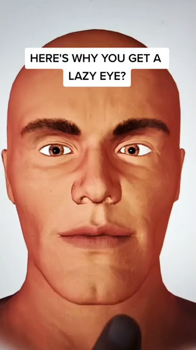 This Gets You a Lazy Eye