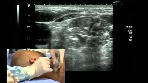 Interscalene Block (ultrasound guided - out of plane)