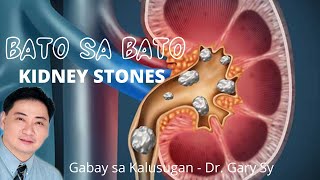 Kidney Stones  Dr. Gary Sy