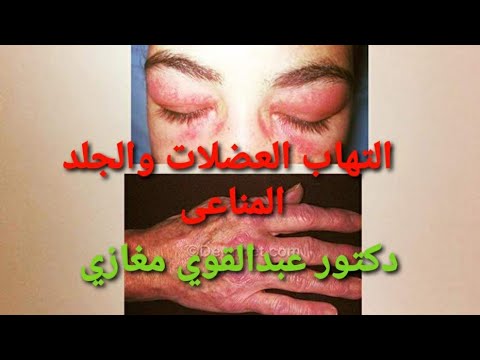 التهاب العضلات والجلد المناعي/dermatomyositis دعبدالقوي مغازي استاذ م الروماتيزم والمناعة ج القاهرة