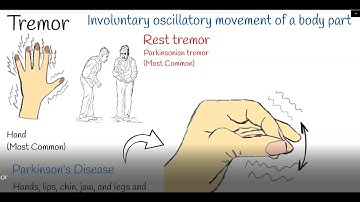 Tremor - Shaking hands (hand tremors) Causes and treatment.  Parkinson or Physiological Tremor?