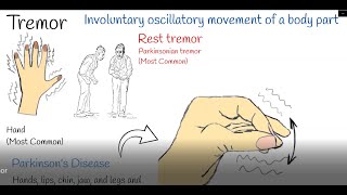 Tremor - Shaking hands (hand tremors) Causes and treatment.  Parkinson or Physiological Tremor? Resimi