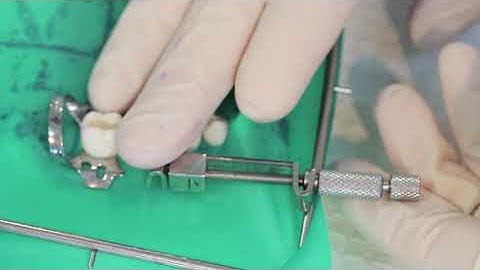 Tofflemire matrix band