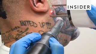 Facial Tattoo Removal