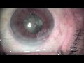 Small pupil cataract surgery with ccc prechopper and c hook
