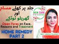 Best Home Remedy for Open Pores on Face, Nose, Hands, cheeks Treatment by Dr Aisha Ghias Part 2