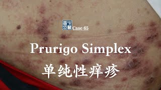 Prurigo Simplex treated by natural and safe way