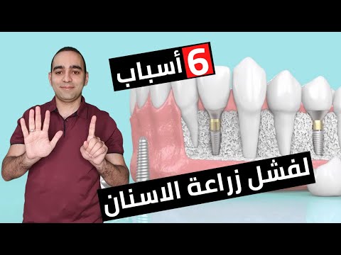 اسباب و علامات فشل زراعة الاسنان | معلومة سريعة