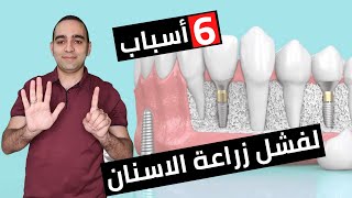 اسباب و علامات فشل زراعة الاسنان | معلومة سريعة