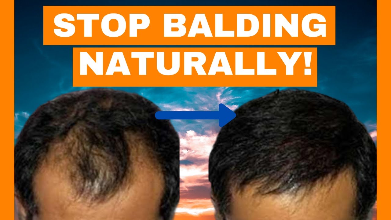 How To Regrow Hair And Stop Balding Naturallymen And Women Youtube