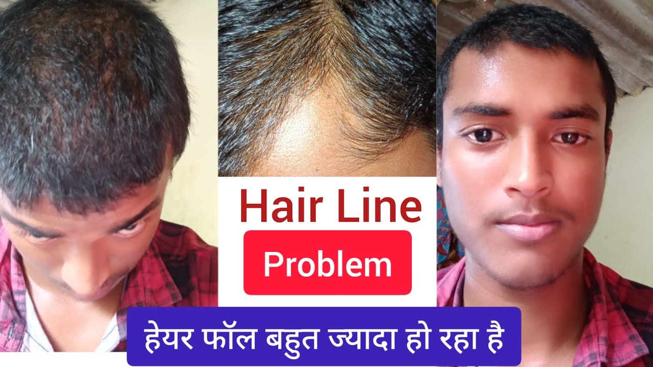 हेयरलाइन पीछे जा रही है क्या करू / How to Grow Receding Hairline YouTube