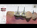 3shape implant studio 2020 detailed workflow