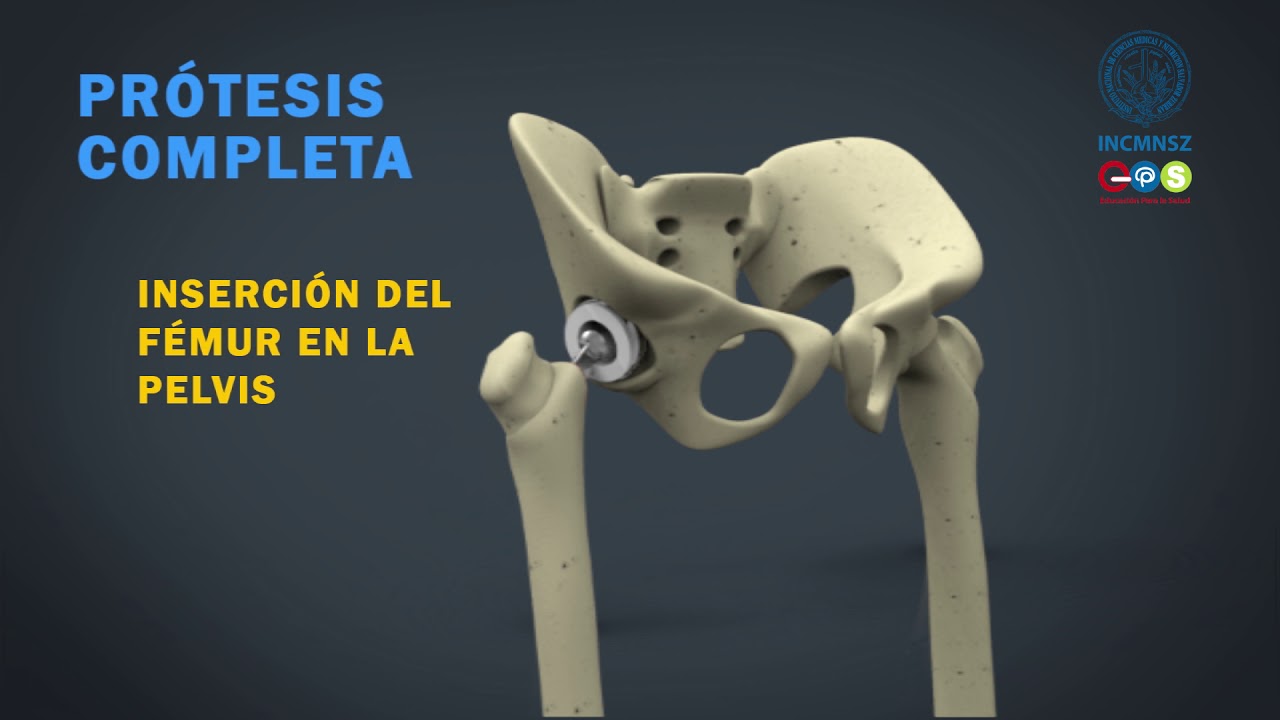 Reemplazo total de la cadera - INCMNSZ - Educación para la Salud