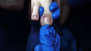 Satisfying nail cleaning process#nailcare #pedicure #satisfying #nailtech #oddlysatisfying #fyp