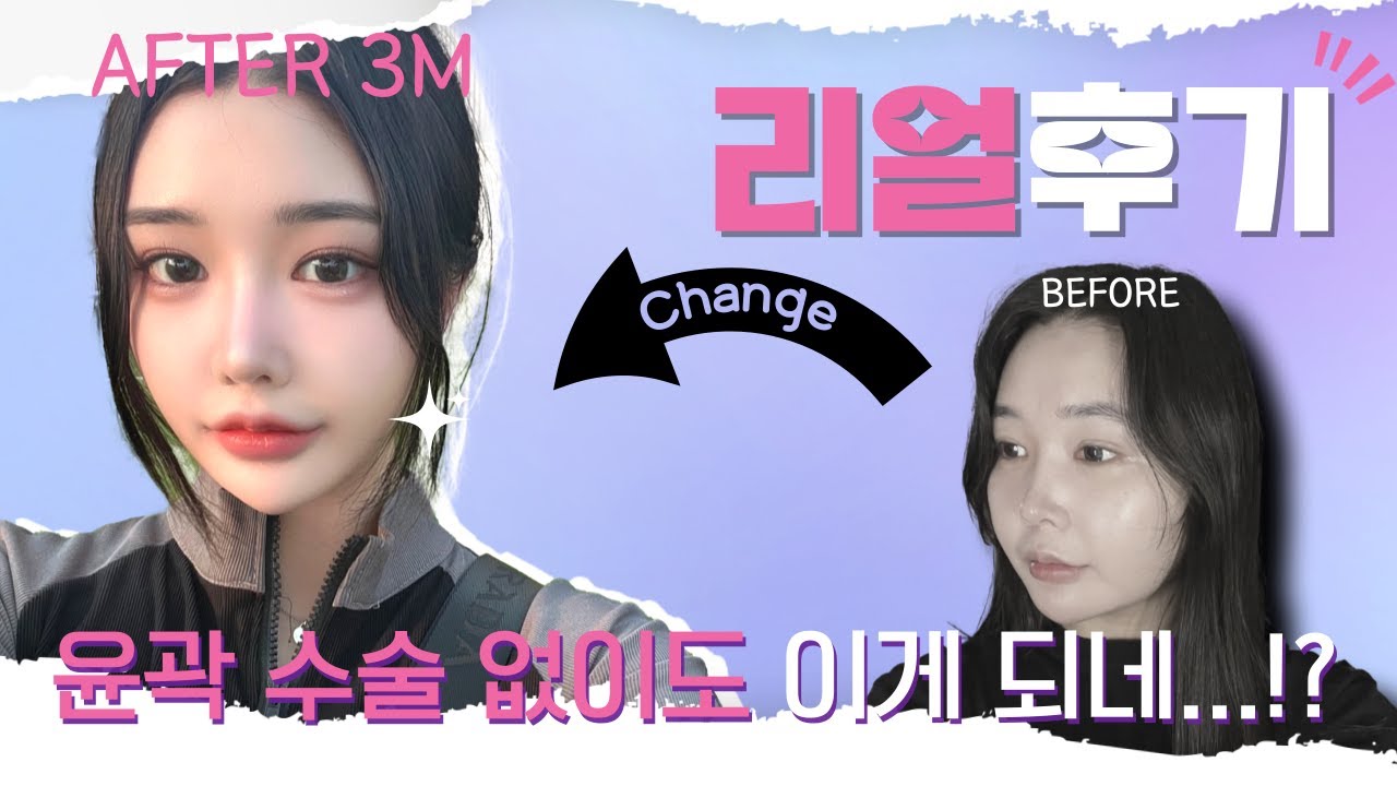 [Эйтоп гоо сайхны мэс заслын эмнэлэг] Нүүрний хэлбэр засах мэс засал - Үгүй! Эйтоп нүүрний өөх соруулах+утастай өргөлтийн бодит сэтгэгдэл 😮