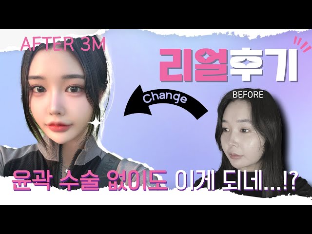 윤곽수술 NO! I 에이탑 얼굴지방흡입+실리프팅 리얼후기 😮