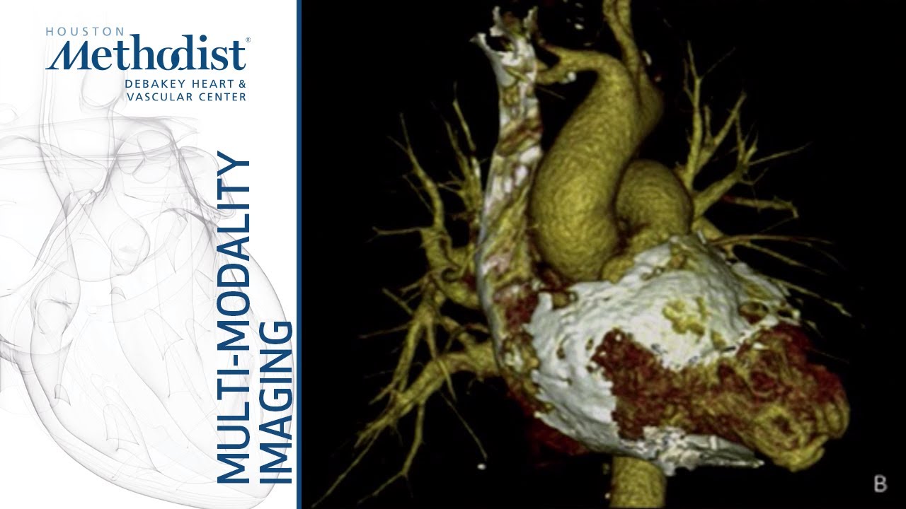 Pericardial Diseases: CT/MRI/Echo-Complementary or Redundant? (Kurrelmeyer, MD; Nabi, MD) 12/17/19
