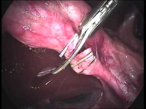 Lap Cholecystectomy (unedited-124)-Chronic Cholecystitis With Adherent Liver To Ant  Abdominal Wall