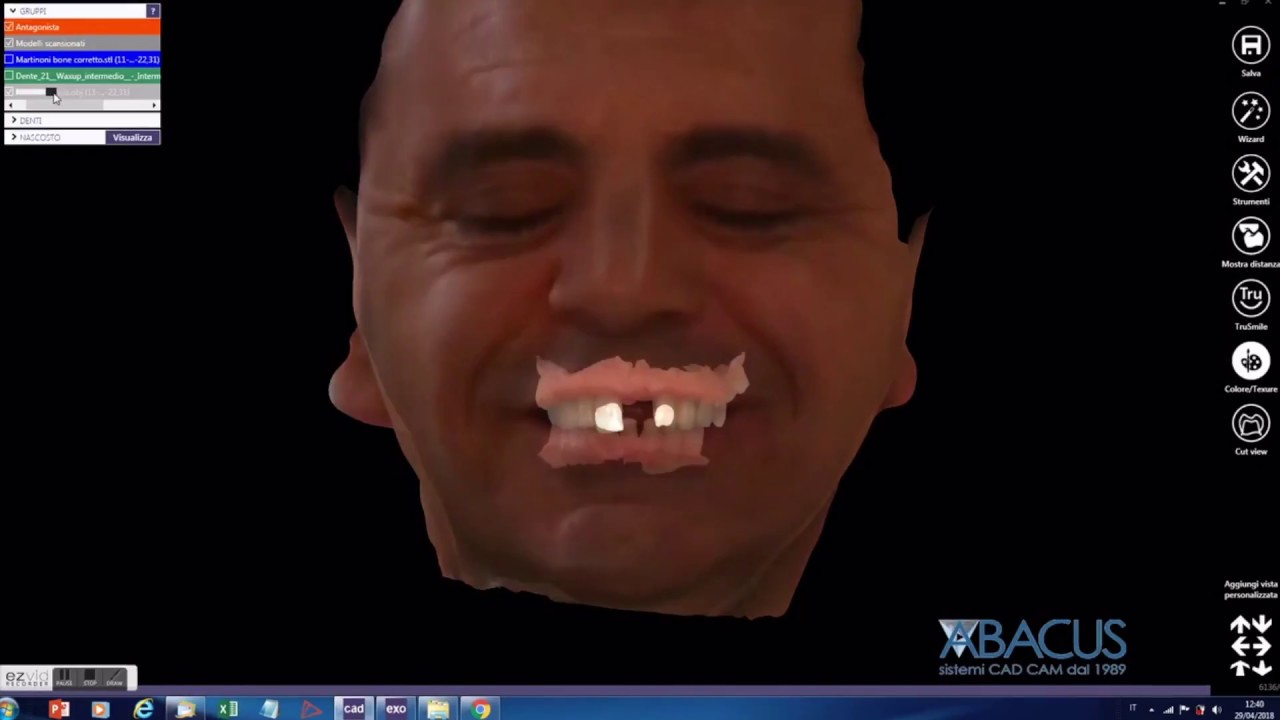 ObiScanner: Superimposition with Exocad