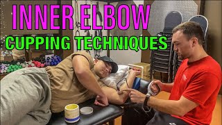 Medial Elbow Cupping Therapy Techniques