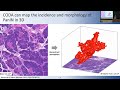 3D reconstruction of human pancreatic precancers reveals novel microanatomical phenotypes