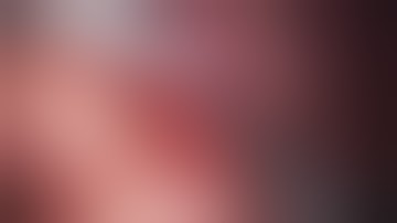 SA-14 ZERO ISCHEMIA LAPAROSCOPIC PARTIAL NEPHRECTOMY  (HILER MASS), CHALLENGE CASE. SERDAR AYKAN,MD