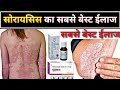 सोरायसिस का सबसे बेस्ट ईलाज // Psoriasis treatment in hindi // Chronic skin allergy