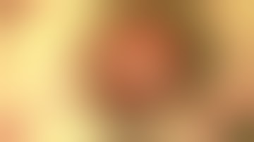 Complex optic capture of dislocated lens and PPV by Steven G. Safran MD