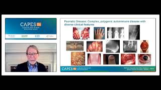 CAPES: Spondyloarthritis and Psoriatic Arthritis Treatment Update Clinician CME Webinar by SPONDYLITISdotORG 2,805 views 1 year ago 1 hour, 53 minutes