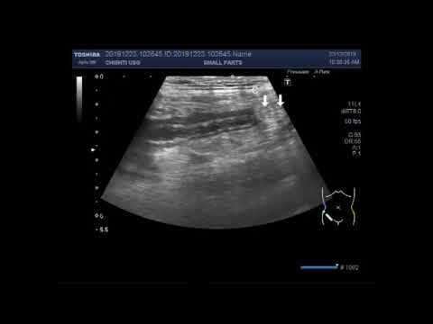 Ultrasound Video showing the focusing and scanning of acute appendicitis.