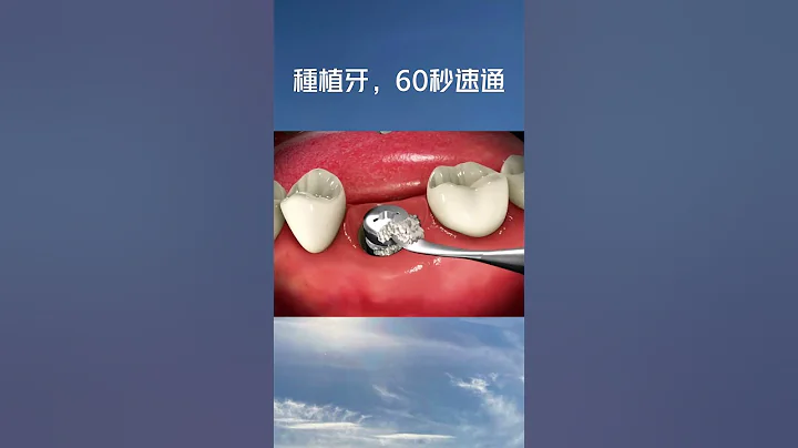 🦷 失去牙齿不再是问题！ 现代植牙技术，恢复自信笑容！ 🌟#dentist #口腔健康 #植牙 - 天天要闻